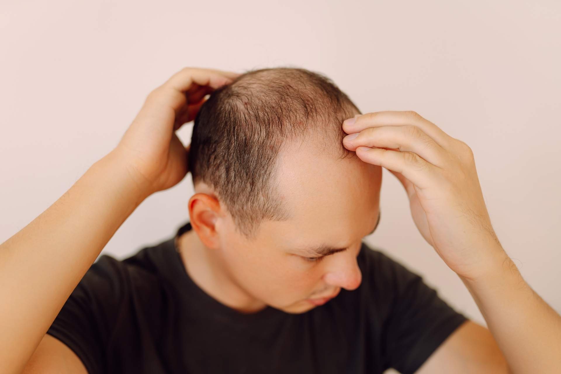 Minoxidil 2% ou 5% : lequel choisir pour une repousse optimale des cheveux ?